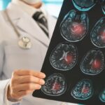 neurologista-explica-o-que-e-um-avc-e-quais-sao-os-principais-sintomas