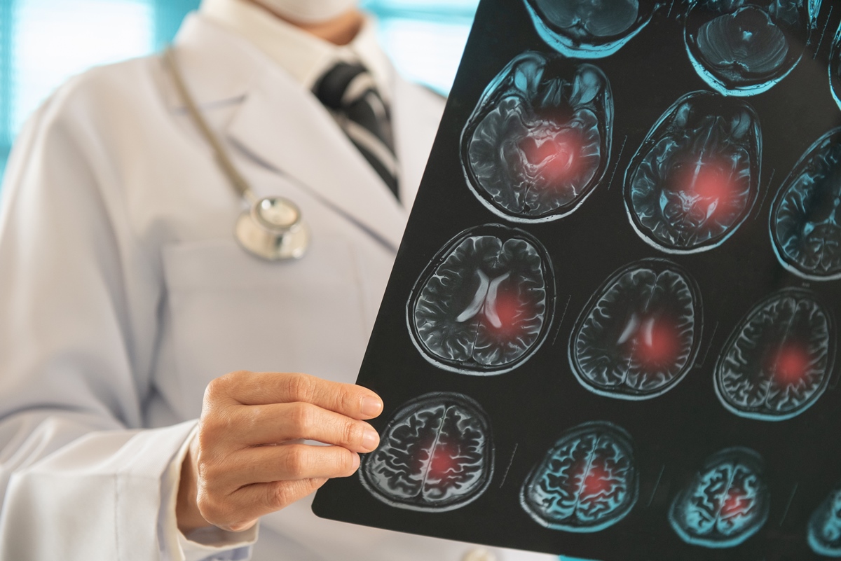 neurologista-explica-o-que-e-um-avc-e-quais-sao-os-principais-sintomas