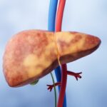 hepatologistas-citam-riscos-da-gordura-no-figado-para-a-saude-em-geral