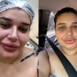 maquiadora-viraliza-com-labios-inchados-apos-remover-preenchimento