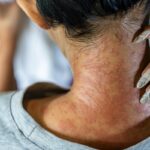 dermatilomania:-psiquiatra-cita-quando-procurar-ajuda-para-tratamento