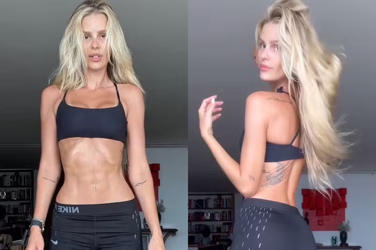 antes-e-depois-de-yasmin-brunet-apos-tratar-lipedema-e-impressionante