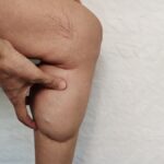 medico-indica-6-chas-naturais-que-auxiliam-no-tratamento-do-lipedema